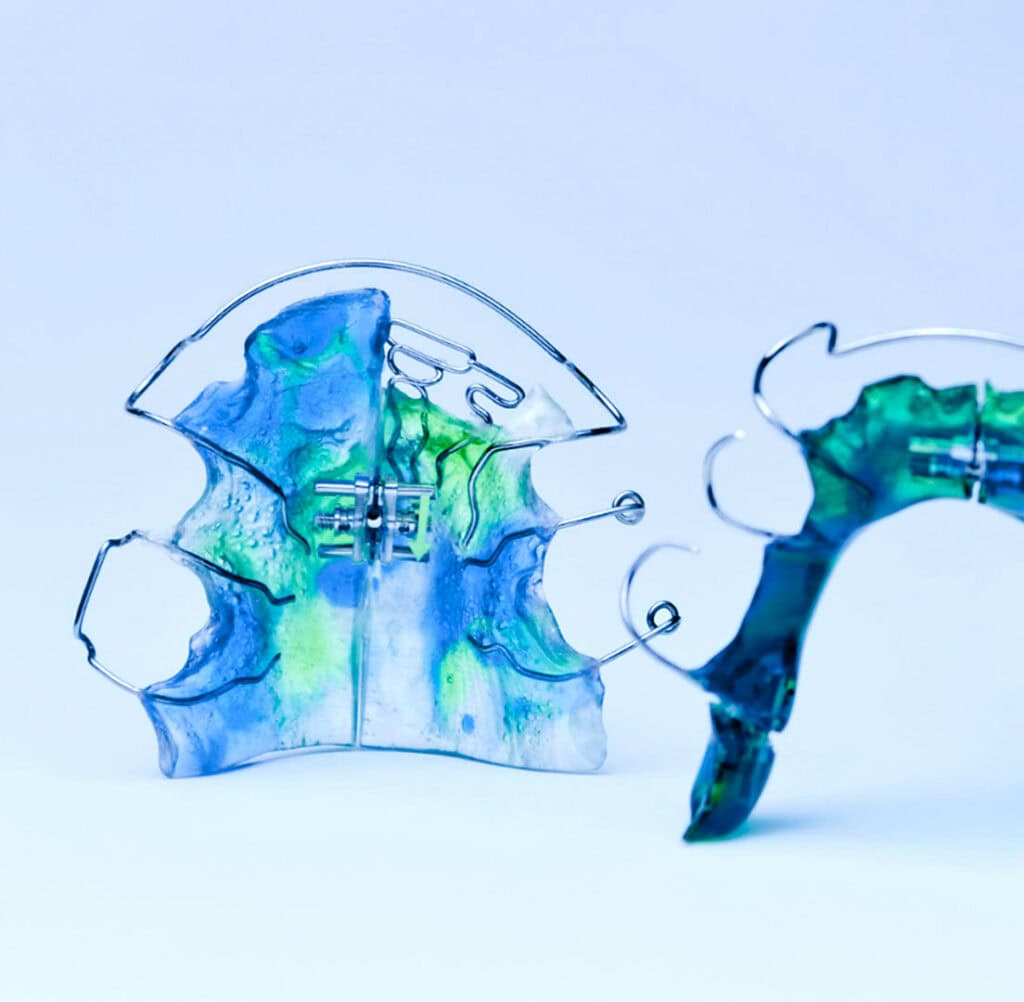 Herausnehmbare kieferorthopädische Apparatur aus Kunststoff und Draht